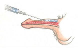 Wstrzykiwanie kwasu hialuronowego pod skórę w celu pogrubienia penisa