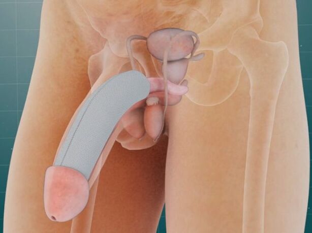 Penis po wprowadzeniu specjalnego implantu pod skórę