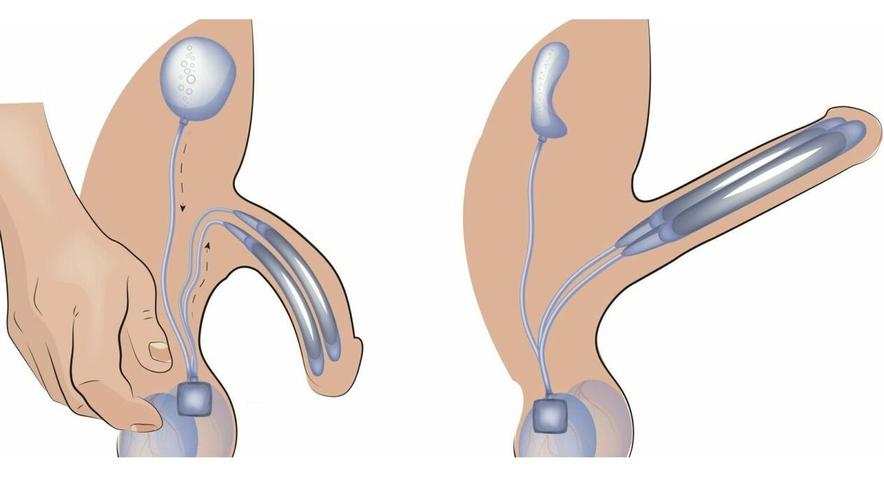 proteza prącia na powiększenie penisa